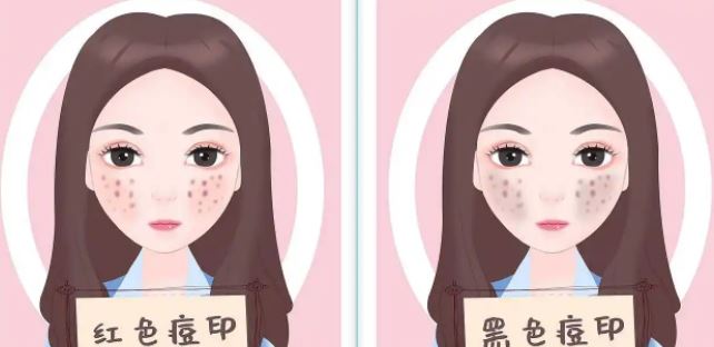 臉上紅色痘印幾個月都不消怎么辦？紅色痘印應(yīng)該怎么消除？