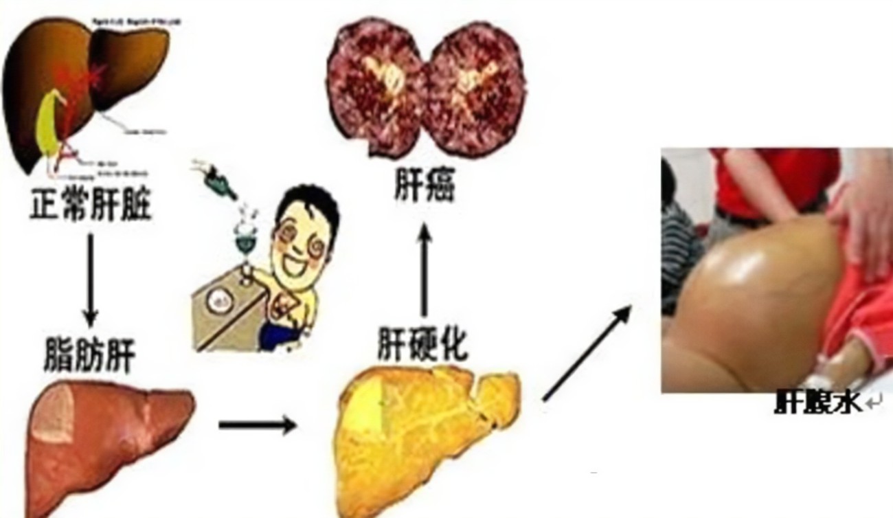 查出肝硬化還有救嗎？