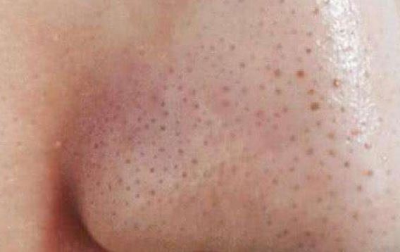 清潔面膜哪個(gè)牌子可以快速祛黑頭？趙薇、薇婭 推薦的紐西之謎泥膜真的好用嗎？